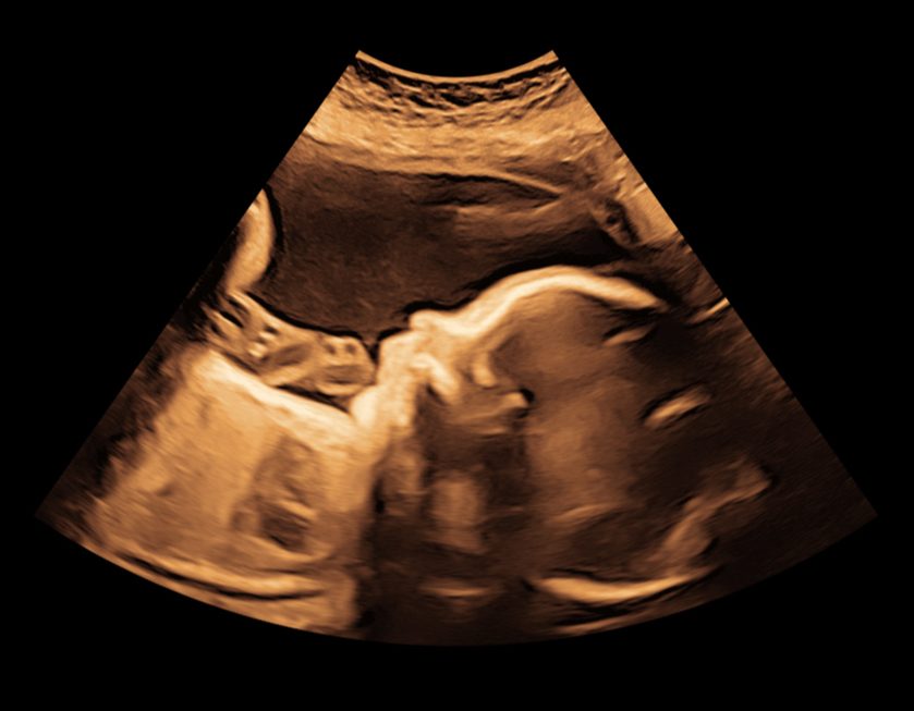 2D image of the baby in the womb